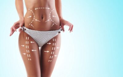 Liposuction Torso Definition: Body Sculpting With Lipo