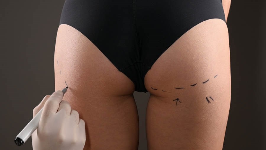 Anti-Cellulite Treatment. Lifting Up Lines Drawn On Perfect Female