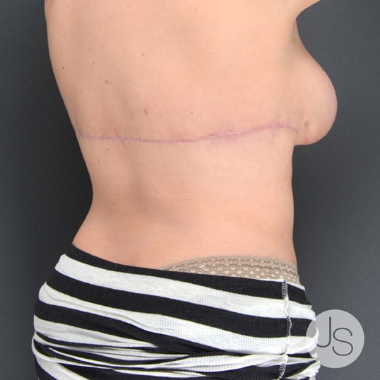 Bra Line Back Lift Before & After Photos Patient 1001680, Serving  Rochester, Syracuse & Buffalo, NY